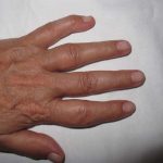 Figura 1. Dactilitis en mano derecha.